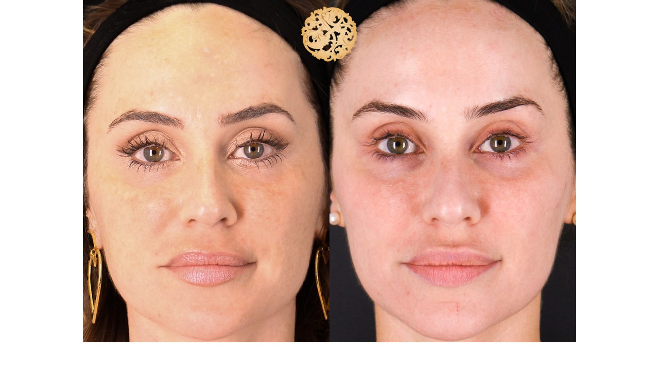Halo Procedure Before and After