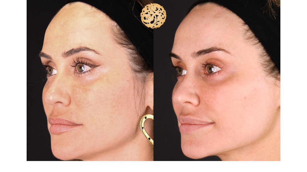 Halo Procedure Before and After