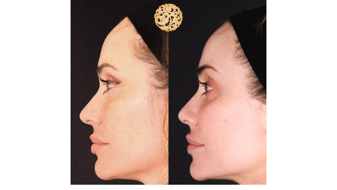 Halo Procedure Before and After