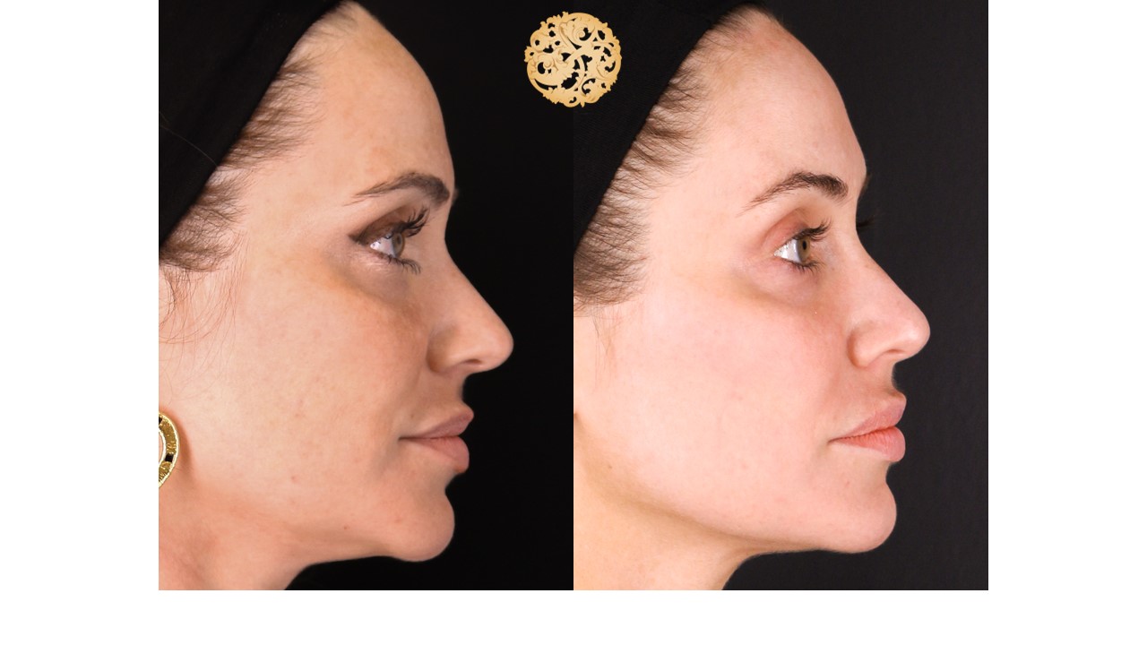 Halo Procedure Before and After