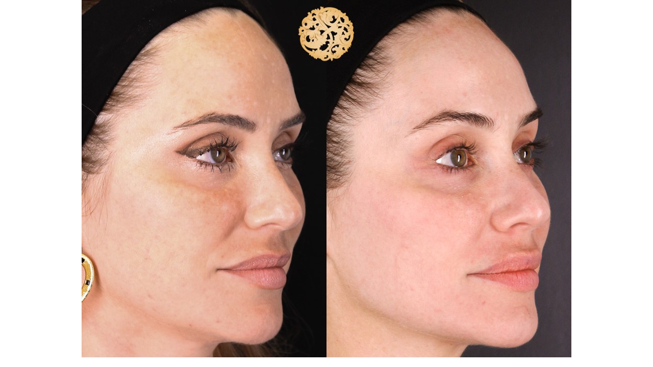 Halo Procedure Before and After